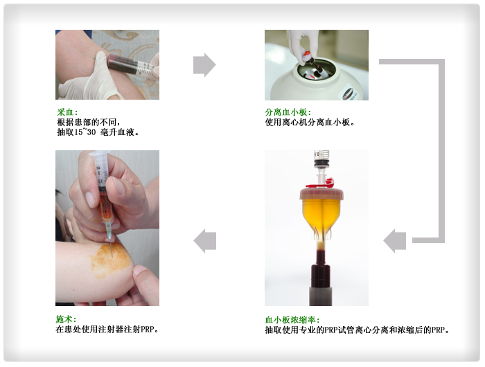 Bood collection: collects 15ml~30ml of blood depending on the treatment area, Platelet separation:Separates platelet using a centrifuge, Concentrates extracted platelet with a centrifuge using a special kit, Injects the concentrated platelet to the treatment area using an injector
