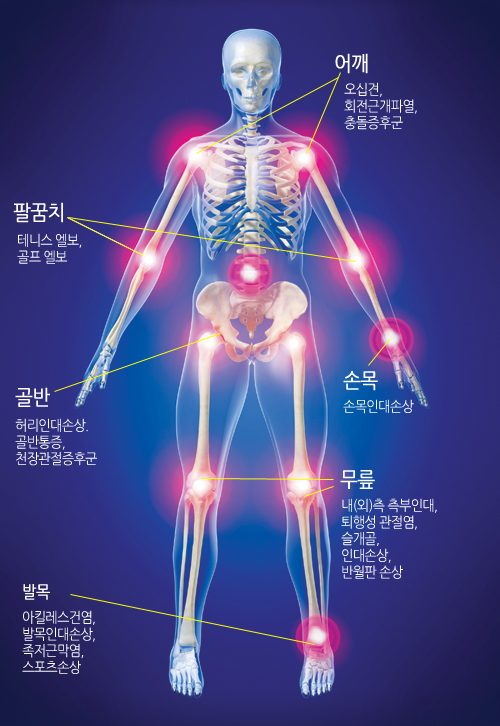 ���: ���ʰ�, ȸ���ٰ��Ŀ�, �浹���ı�, �Ȳ�ġ: �״Ͻ� ����, ���� ����, �ո�: �ո��δ�ջ�, ���: �㸮�δ�ջ�, �������, õ��������ı�, ����: ��(��)�� �����δ�, ���༺ ������, ������ �δ� �ջ�, �ݿ��Ǽջ�, �߸�: ��ų�����ǿ�, �߸��δ�ջ�, �����ٸ���, �������ջ�