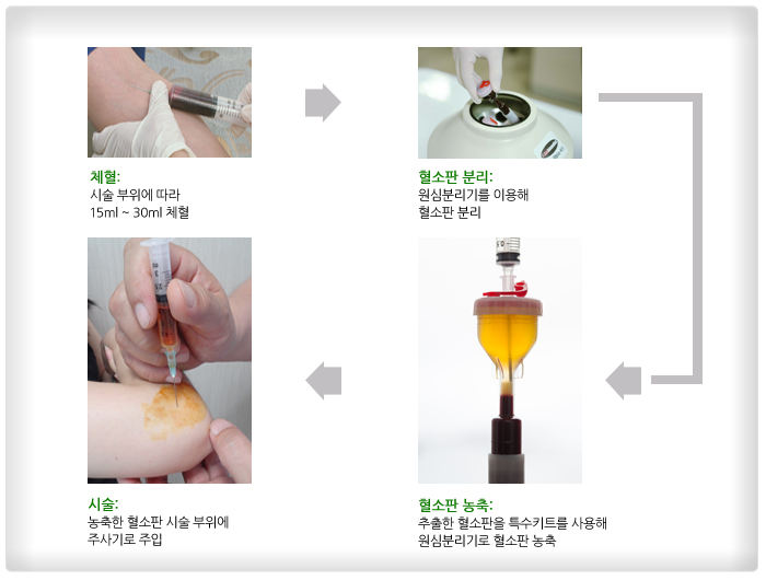 ä��: �ü� ������ ���� 15ml ä��, �����Ǻи�: ���ɺи��⸦ �̿��� ������ ����, ������ ����: ������ �������� Ư��ŰƮ�� ����� ���ɺи���� ������ ����, �ü�: ����� PRP�� �ü� ������ �ֻ��� ����